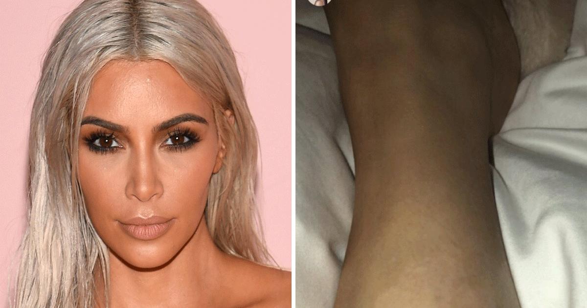 Kim Kardashian says her psoriasis has 'taken over' her body. Here's