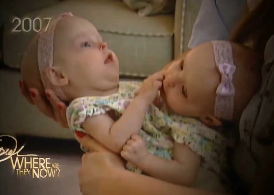 Uspele su da pobede visoku stopu smrtnosti kod sijamskih blizanaca