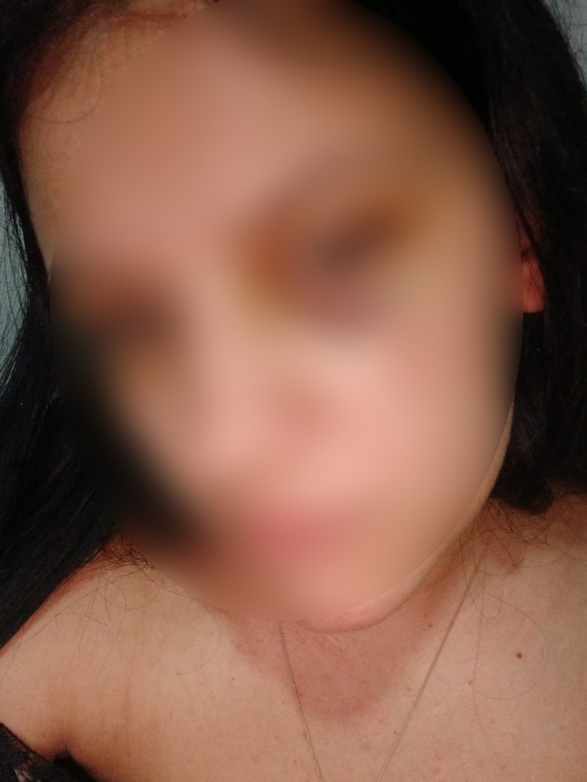 Ovako je nakon napada izgledala Srpkinja koja je pretučena u Beranama