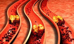 Od czego zacząć obniżanie cholesterolu? Praktyczne wskazówki od kardiologa i dietetyczki