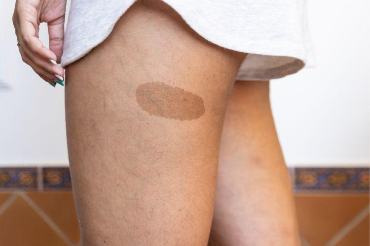 Birthmark on thigh [SunDoctors]