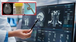 Przerażające odkrycie. Lekarze znaleźli to w głowie kobiety. Pierwszy taki przypadek na świecie