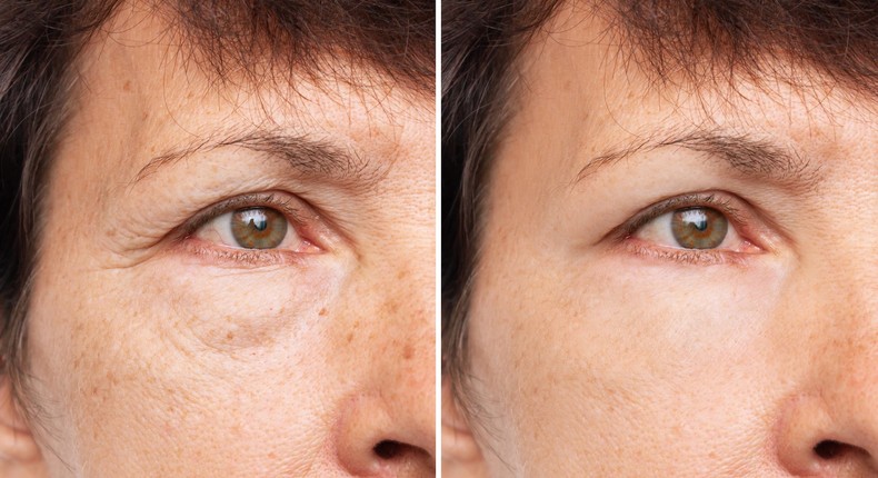 Blepharoplasty candidates are typically patients in their fifties at least, but plastic surgeons say more and more young people have been asking about eye lifts lately.  Marina Demeshko/Getty Images