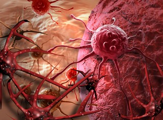 Sztuczna inteligencja ma pomóc w diagnozie i leczeniu chorób onkologicznych