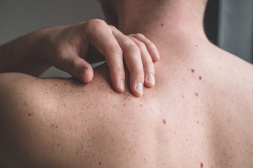 Ha ezeket a tüneteket tapasztalja, irány a bőrgyógyász! Bőrrákot is jelezhetnek