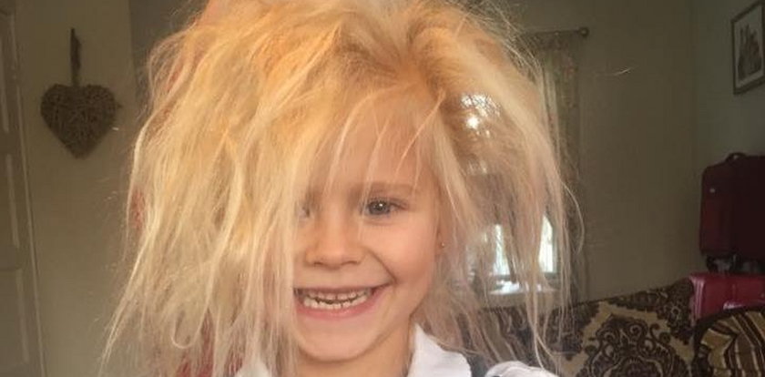 7-latka cierpi na rzadką chorobę. Zobacz jej włosy!