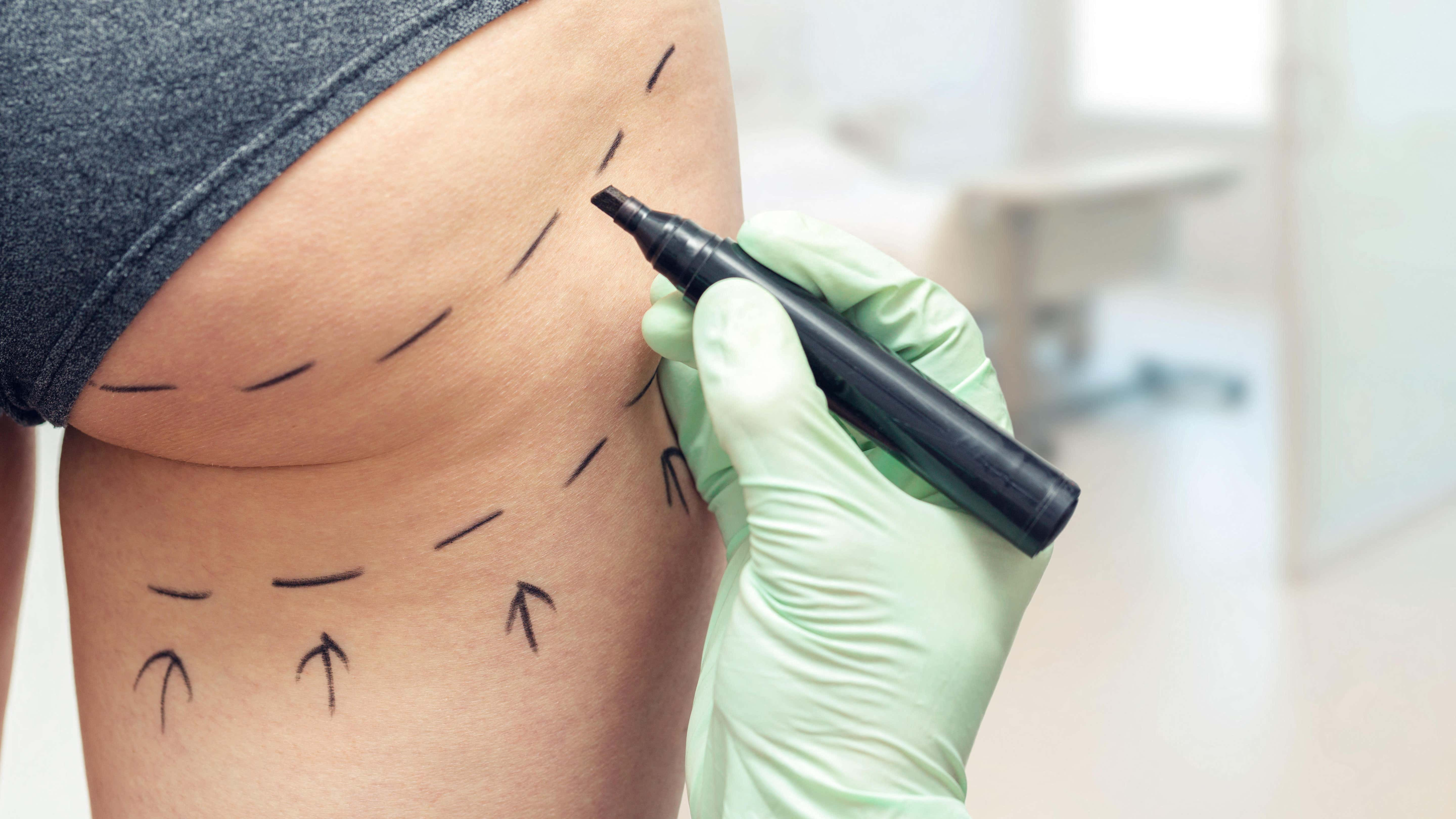 The cosmetic procedure detail MPs call a "wild west" - and why it's killing people