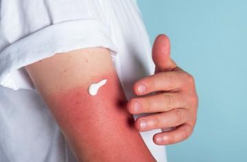 A kisebb bőrfelületen kialakult vagy enyhébb napégésre semleges, hűsítő vizes rázókeverékek, vizes bázisú kortikoszteroid krémek a legjobbak és a többszöri hideg folyóvizes hűtés.