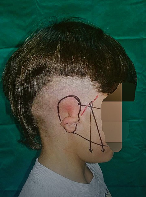 Lekar pre operacije izračunava veličinu i položaj ušne školjke