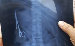 18 lat nosił zaszyte w brzuchu... nożyczki. Chirurg zgubił je w czasie operacji [ZDJĘCIA]