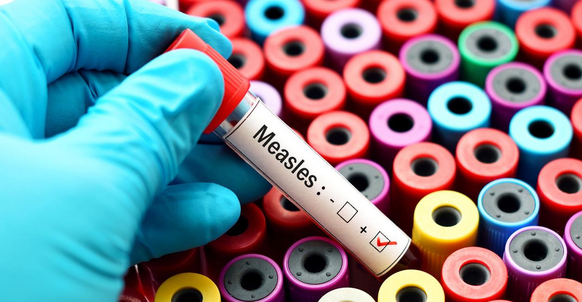 Measles positive
