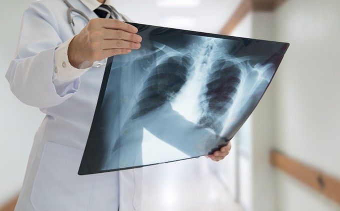 Az orvos elárulja, hogy mit tegyen a COPD-s beteg, ha fellángolnak a tünetei