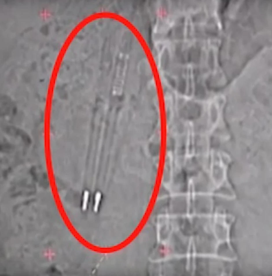 Kinezi su imali sličan slučaj