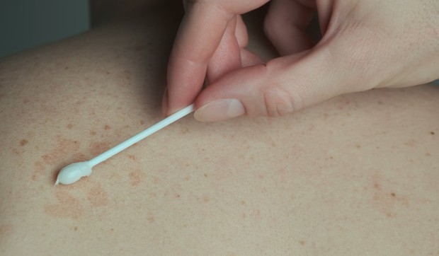 Bris kože može da pomogne u dijagnostici Parkinsonove bolesti