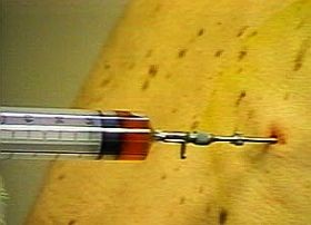 biopsia-diagnosztika-d00000F406cd176780297
