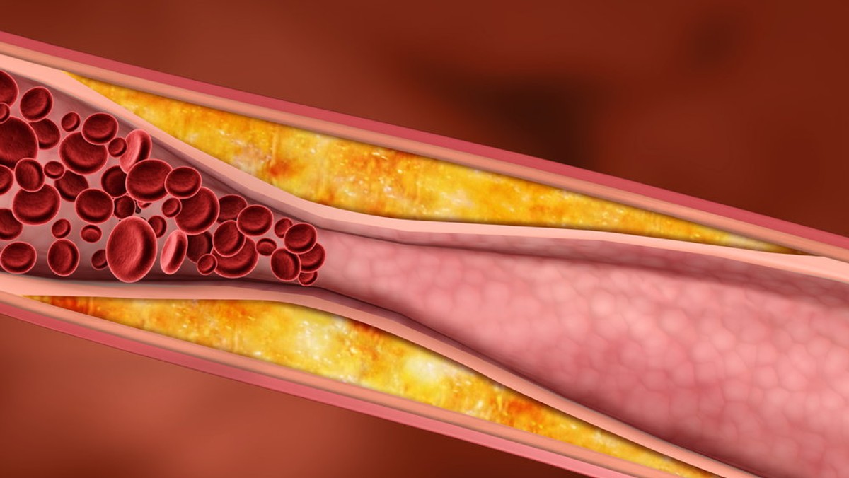 Jedynie u co drugiej osoby, której zlecane jest badanie stężenia lipidów, bezpośrednio we krwi wykonywany jest pomiar poziomu tzw. złego cholesterolu (LDL) – powiedział w poniedziałek w Warszawie na śniadaniu prasowym dr Andrzej Marszałek z Warszawy.