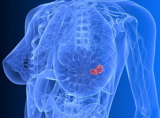 Poznańscy naukowcy opatentowali metodę wykrywania genetycznej predyspozycji do agresywnego raka piersi