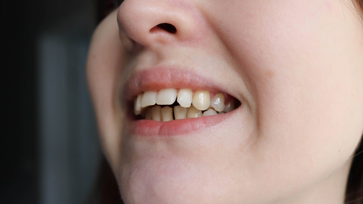 Većina slučajeva malokluzije je nasledna