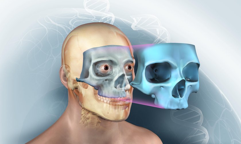 Mam czaszkę dzięki drukarce 3D