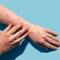 Alaszkai himlő: a tünetek elsőre könnyen összetéveszthetők egy pókcsípéssel