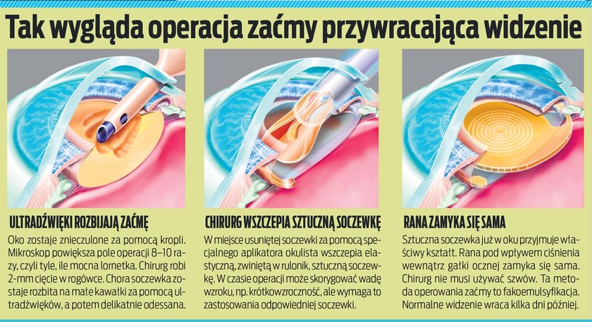 Taki przebieg – schematycznie – ma operacja zaćmy