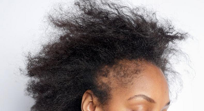 Hair loss, a possible sign of vitamin D deficiency