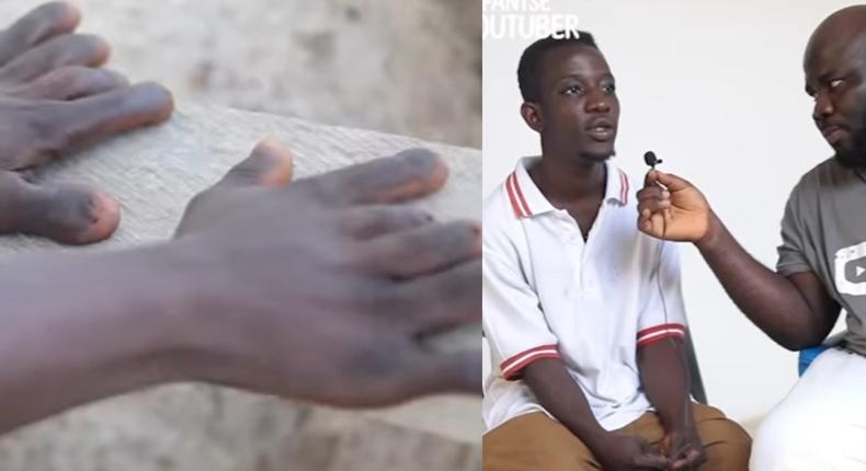 Ghanaian man who has 12 fingers, both penis and vagina begs for help