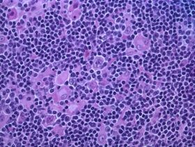 lymphoma-d00001CDA8bdc8fd6089d