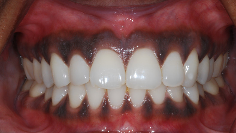 why-some-people-have-black-gums-pulse-kenya