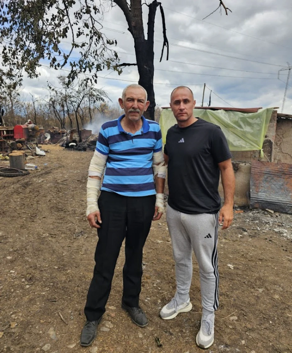 Čovek kome su obe ruke izgorele u požaru