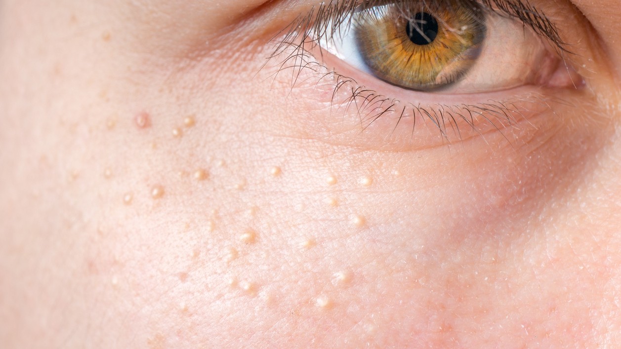 Týchto vyrážok sa dá zbaviť len veľmi ťažko. (ilustračné foto)