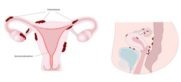 Endometriózis: a bordó, megvastagodott endometriumok a méhben és a környező szerveken is láthatók