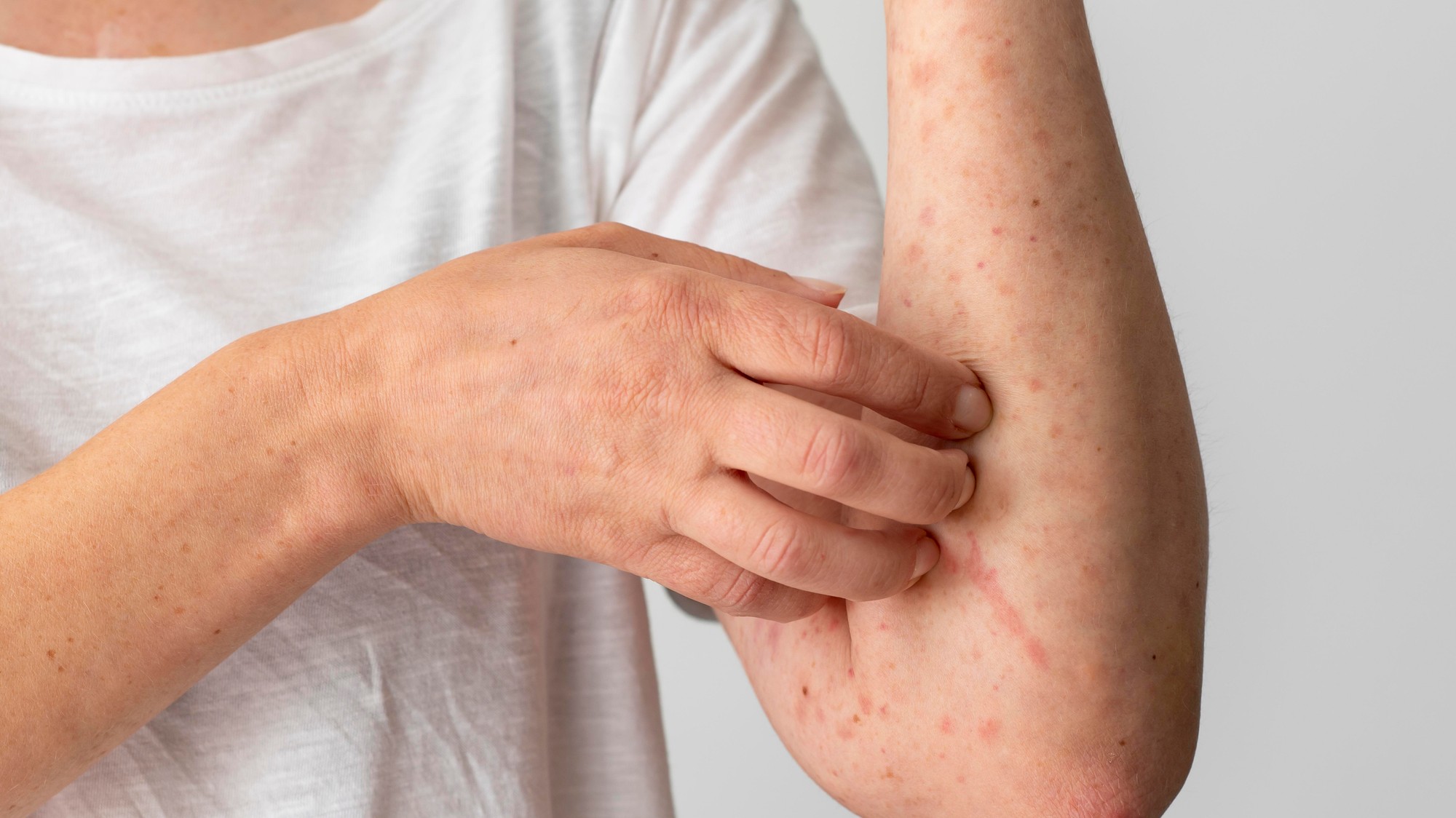 Atopická pokožka má narušenú prirodzenú ochrannú bariéru, kvôli čomu stráca vlhkosť a stáva sa extrémne citlivou na vonkajšie alergény a dráždivé látky.