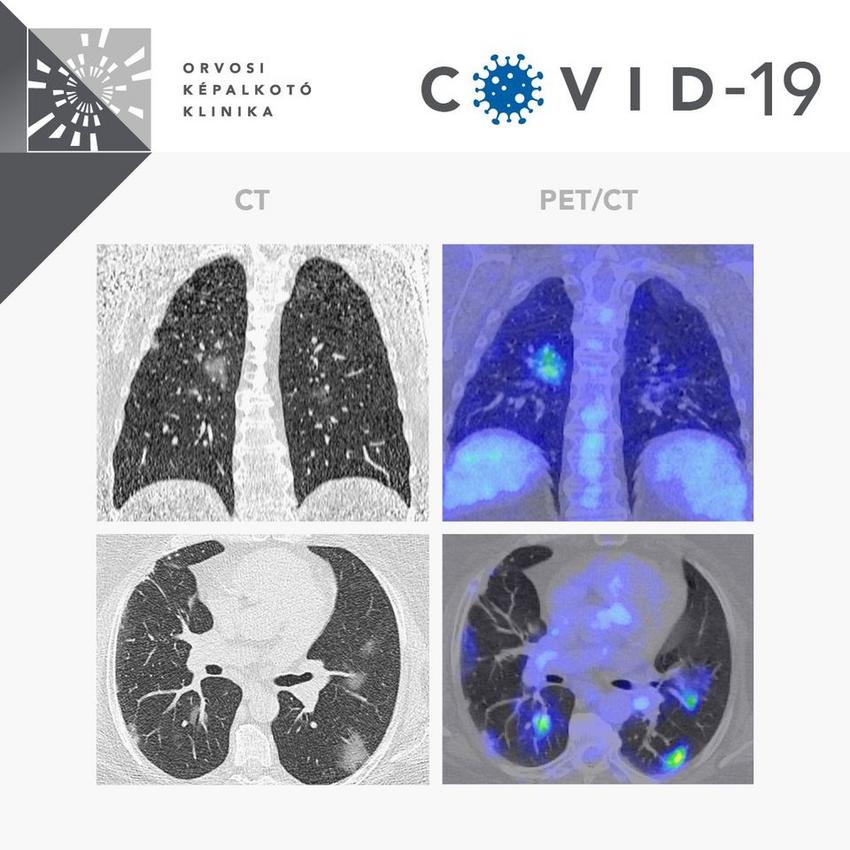Covid-19 beteg tüdeje: CT és PET-felvétel