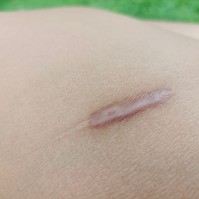 Keloid