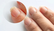 Wysoki poziom cholesterolu widać na paznokciach. Dwa subtelne i wymowne sygnały