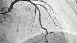 Koronarografia serca - wskazania, przebieg. Jak się przygotować do koronarografii? [WYJAŚNIAMY]