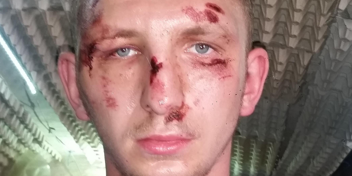 24-letni Kamil oskarża policjantów ze Słupska o brutalne pobicie