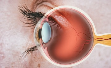 cukorbetegség, diabétesz, szembetegségek, szövődmény, foltok, látás, retinopathia diabetica