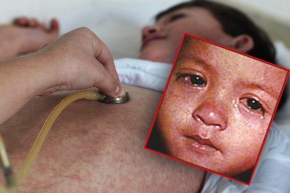 Nemanja je opasan virus dobio sa 6 meseci, oporavio se, ali 3 godine kasnije kreću ZASTRAŠUJUĆI SIMPTOMI: Majka objasnila kroz kakav pakao su prošli zbog malih boginja