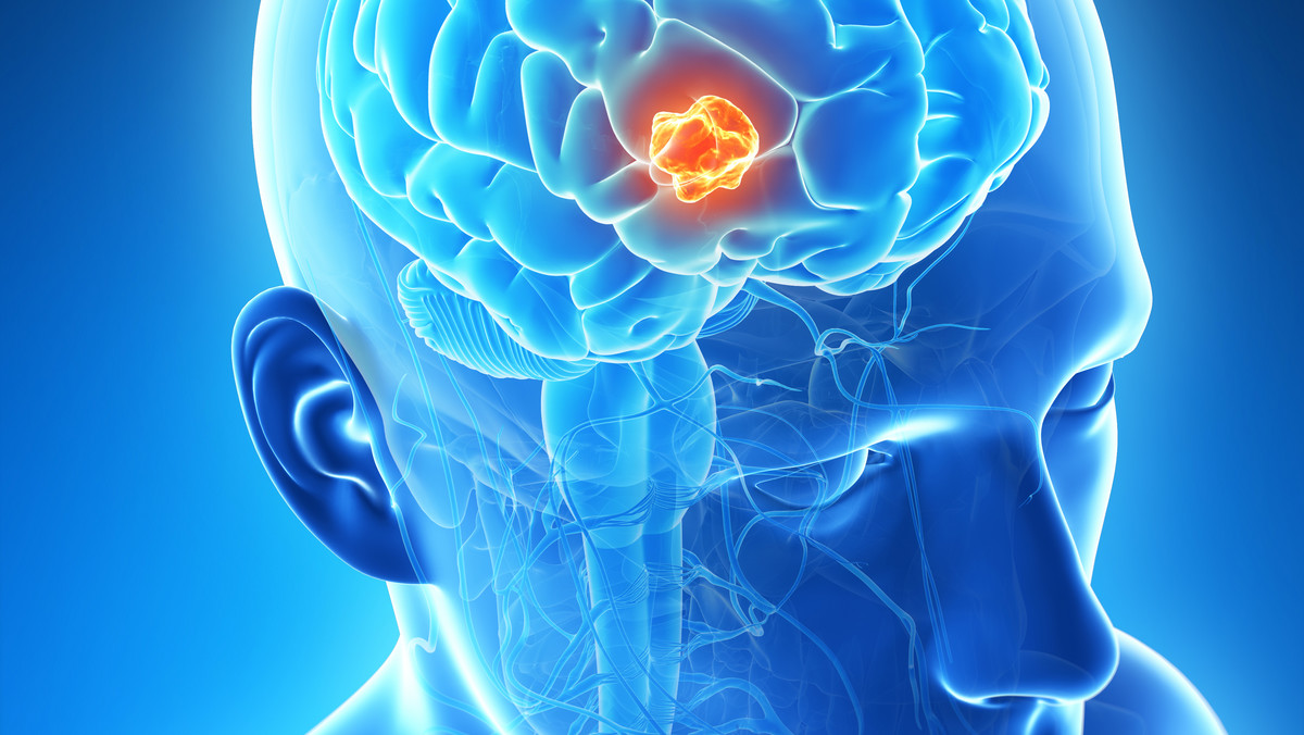 Rak mózgu, nazywany również guzem mózgu, jest niezwykle groźną chorobą. Polska jest czwartym krajem na świecie pod względem zachorowań. Choroba atakuje narząd ośrodkowego układu nerwowego, który odpowiada za podstawowe procesy życiowe.