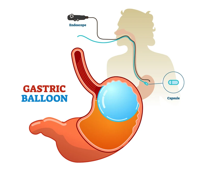 Kroz usta, korišćenjem endoskopa, balon se uvodi u želudac. Zatim, balon je napunjen sa 500-600 kubika fiziološkog rastvora. I nakon toga ostaje u želucu pola godine do godinu dana