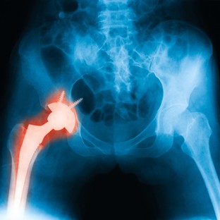 A jövő csontpótlása kinyomtatott implantátummal
