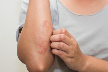 ekcéma, mikrobás ekcéma, nummuláris ekcéma, viszketés, bőrelváltozás, bőrfolt
