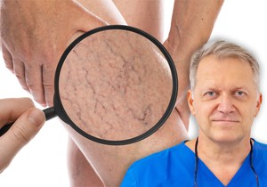 Ljudi očekuju da prvo vide velike plave vene, međutim, često sve počinje mnogo diskretnije, objašnjava vaskularni hirurg dr Dario Jocić