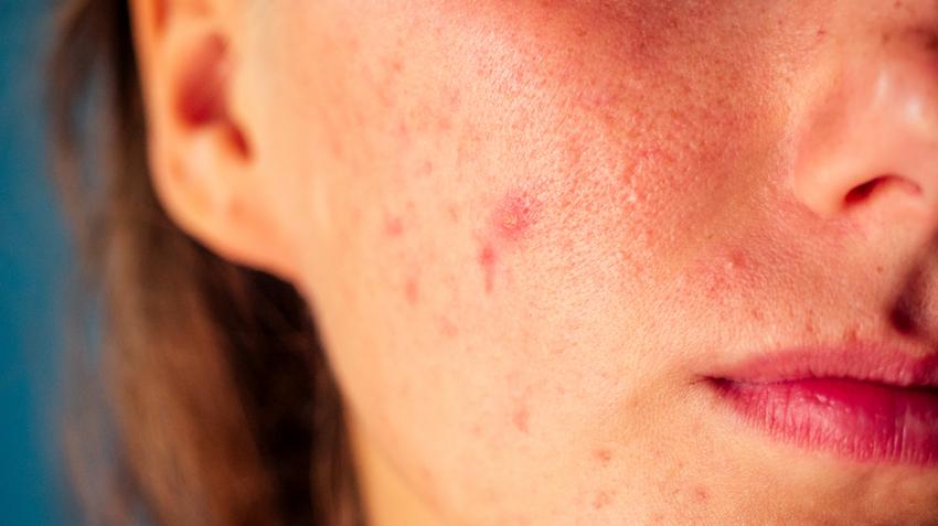 bőrproblémák arcon orvosi felszerelések pikkelysömör kezelése