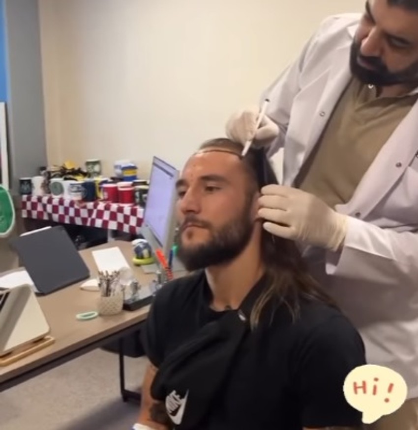 Nemanja Gudelj presađuje kosu