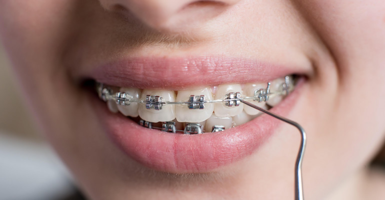Wady zgryzu można skorygować odpowiednio dopasowanym aparatem ortodontycznym