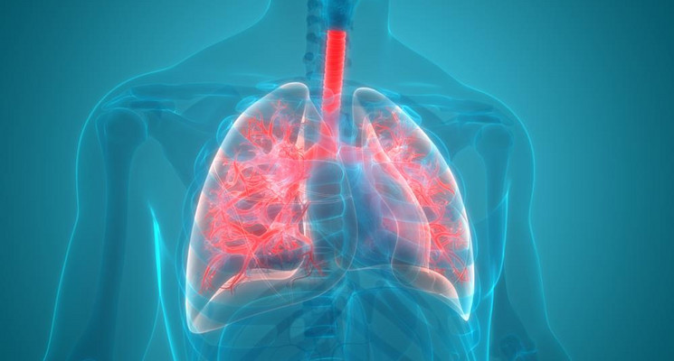 Rak Płuc Nowotwór Płuc Przyczyny Objawy Leczenie 3744