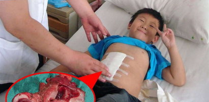 Chłopiec o trzech żołądkach już po operacji